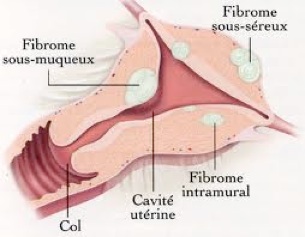 Le Fibrome pathologie